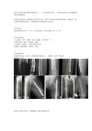 股骨干骨不连的双钢 板治疗