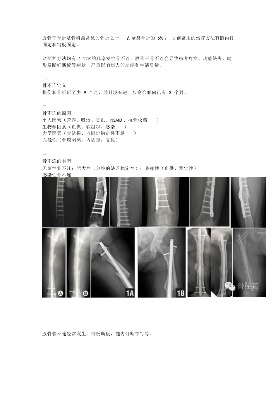 股骨干骨不连的双钢 板治疗_第1页