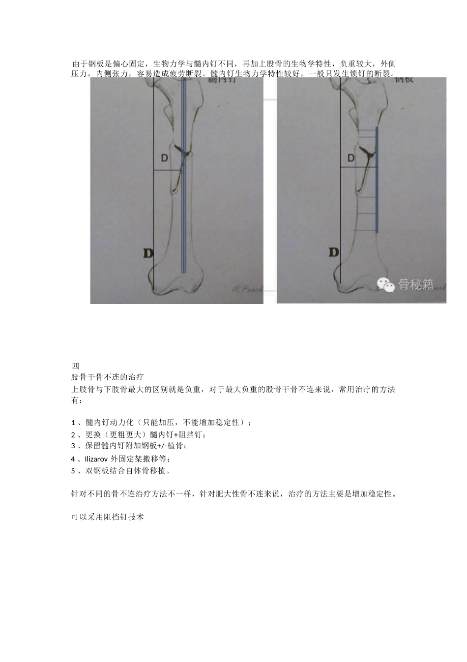 股骨干骨不连的双钢 板治疗_第2页