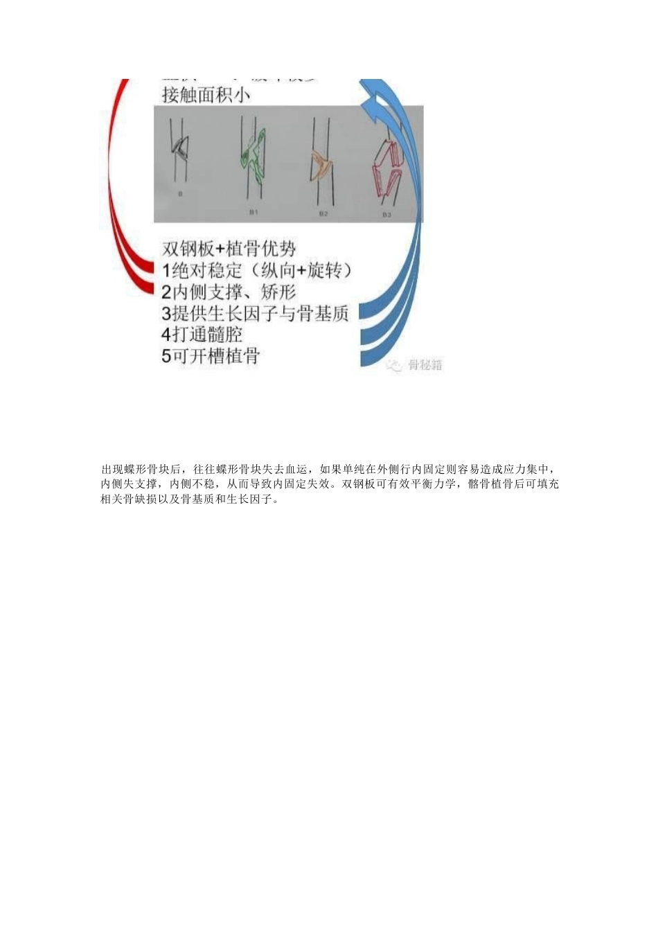 股骨干骨不连的双钢 板治疗_第7页