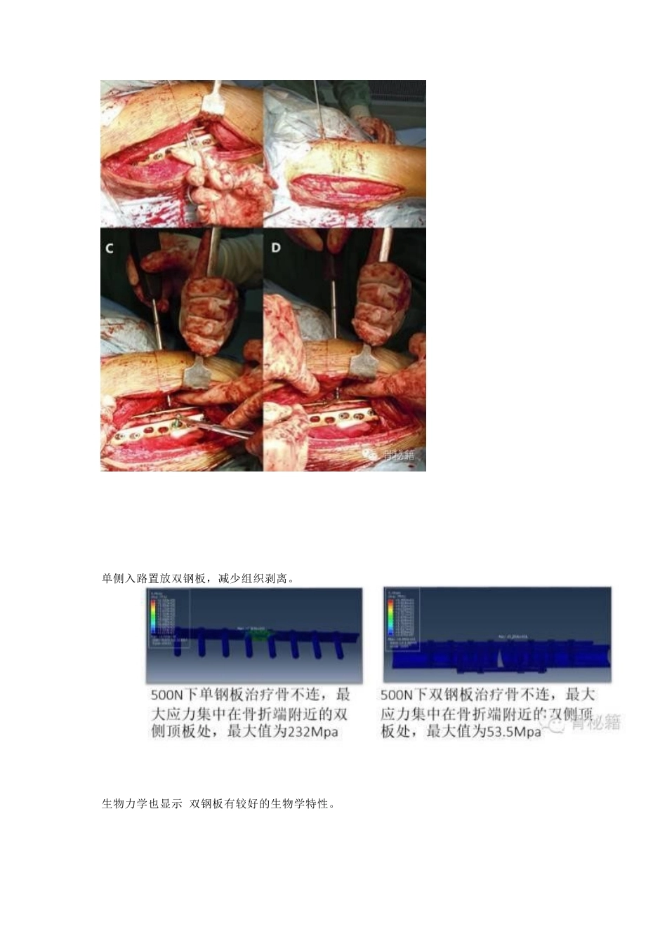股骨干骨不连的双钢 板治疗_第8页
