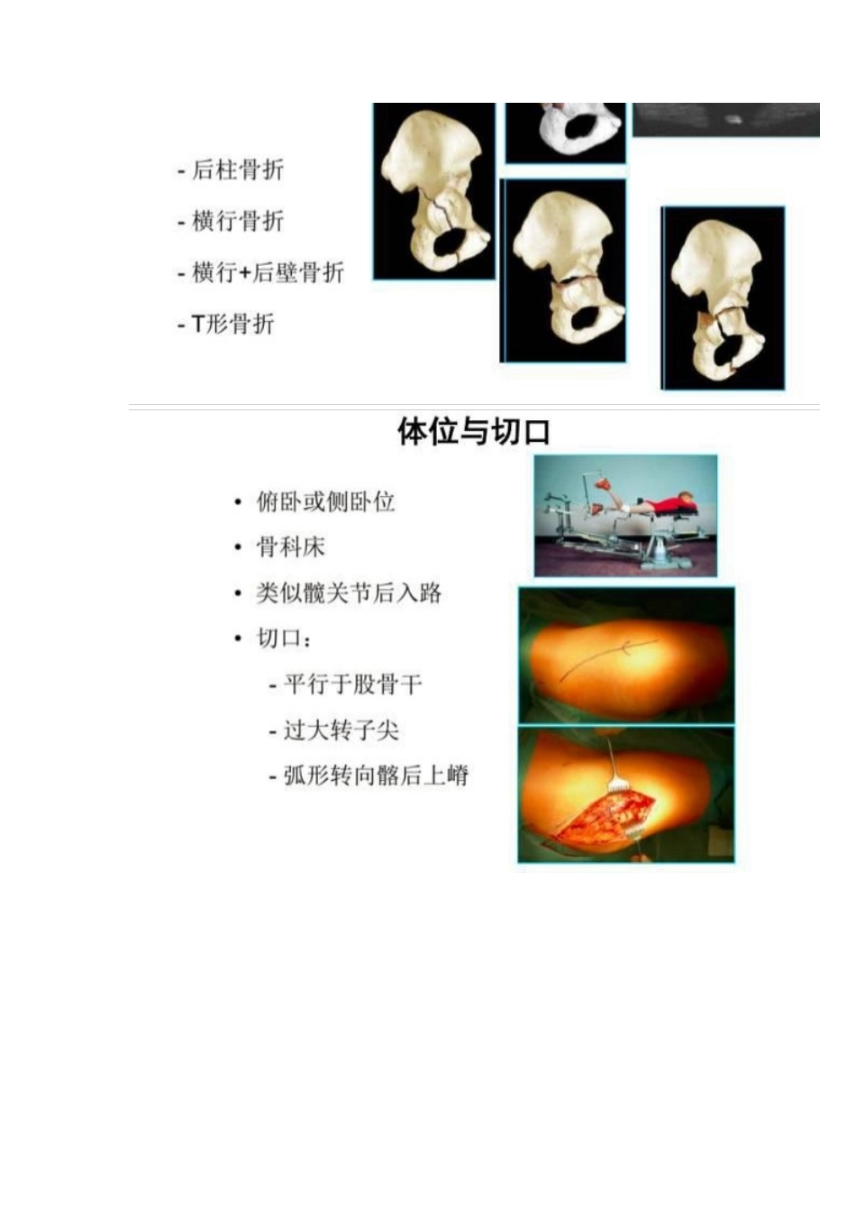 髋部骨折的手术入 路及步骤_第10页