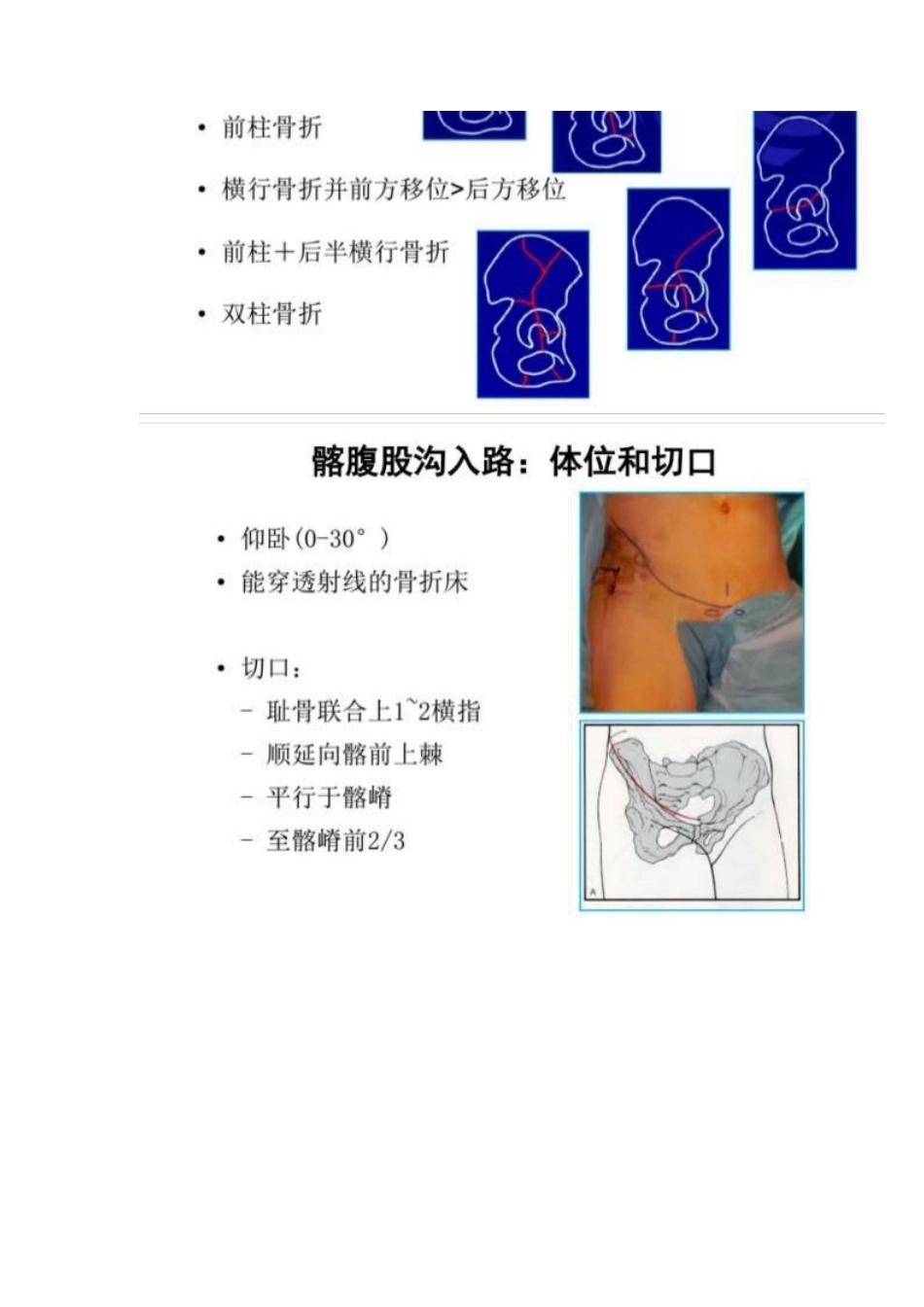髋部骨折的手术入 路及步骤_第3页