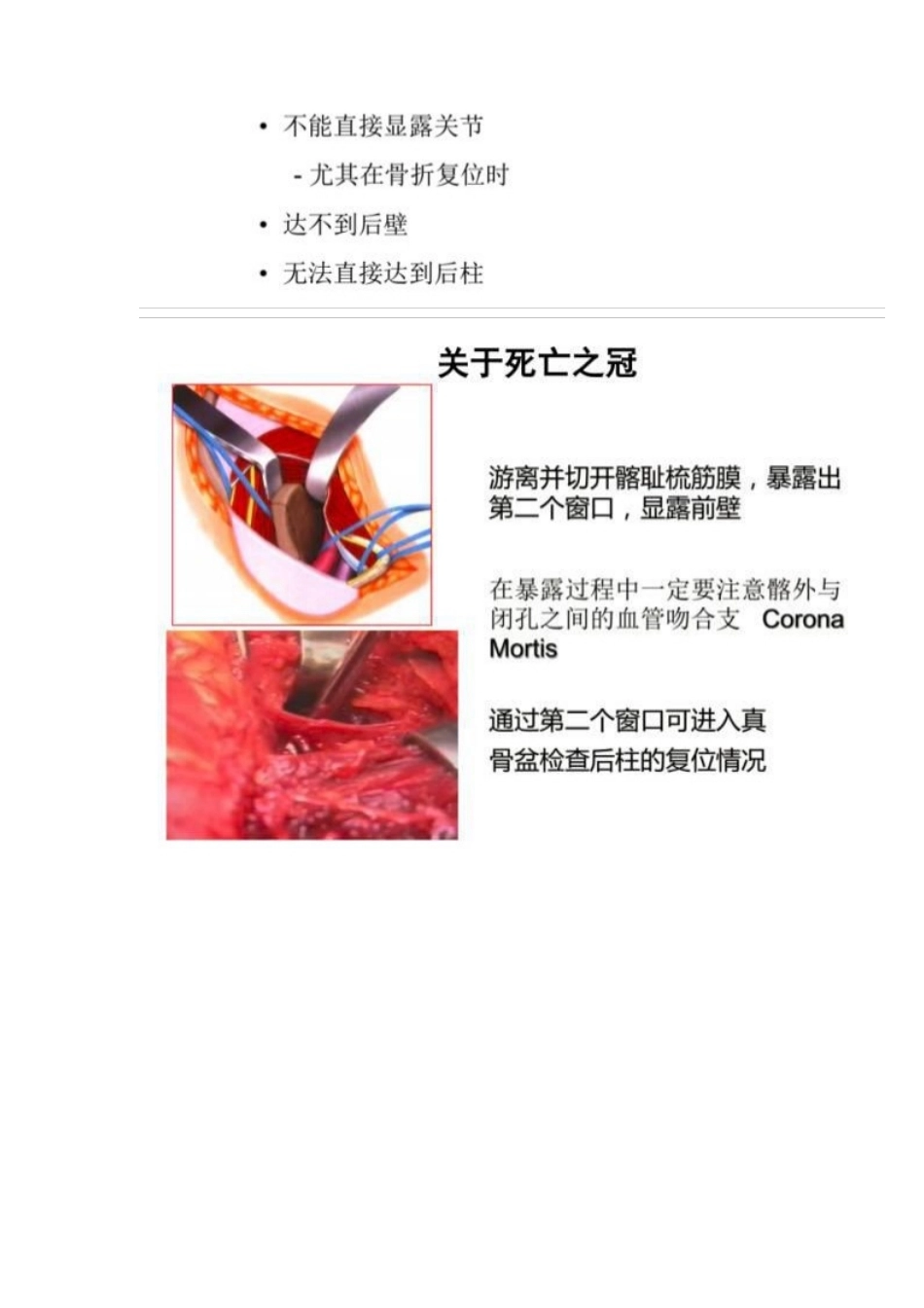 髋部骨折的手术入 路及步骤_第7页