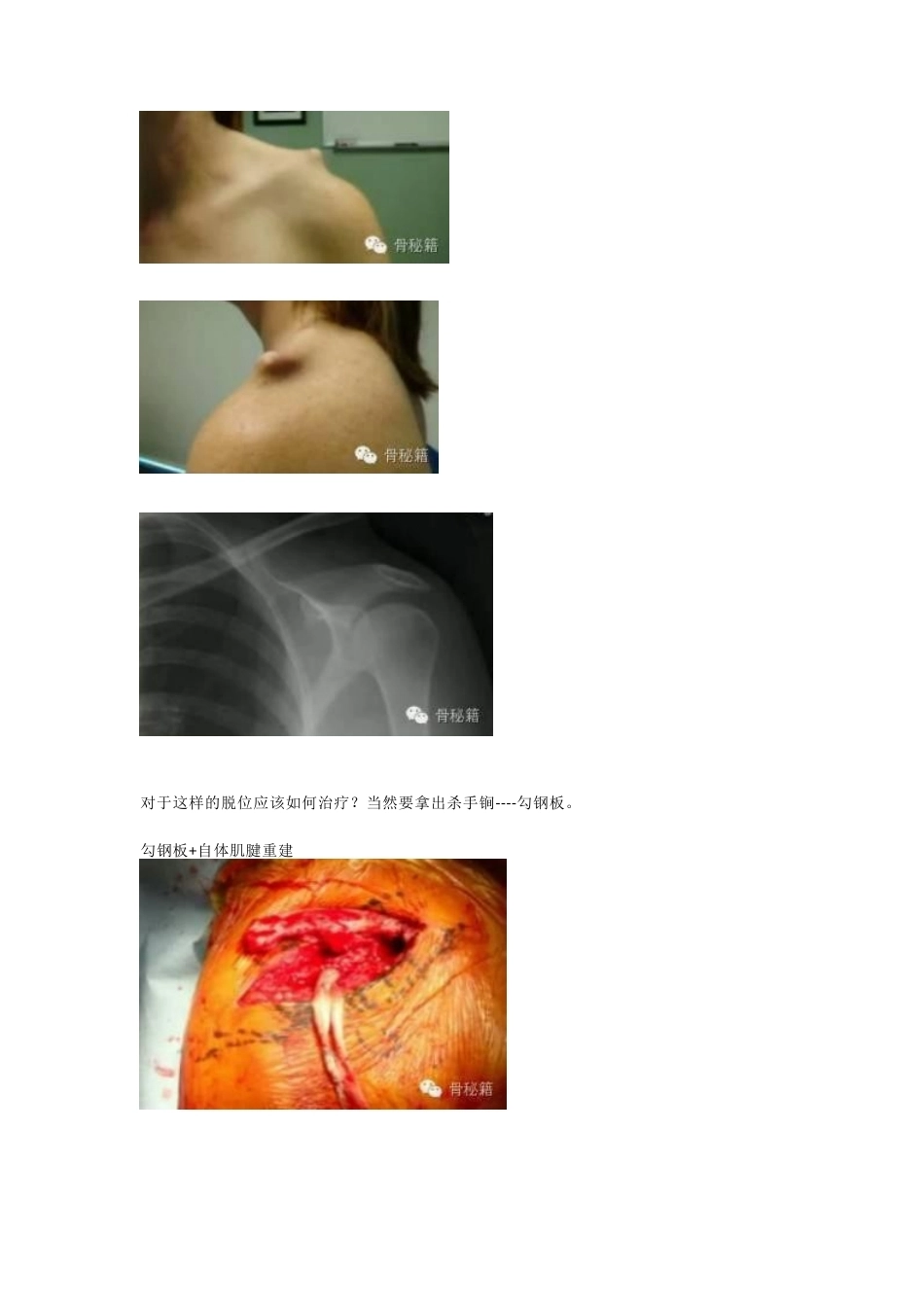 锁骨远端骨折与肩锁 关节损伤的治疗_第4页