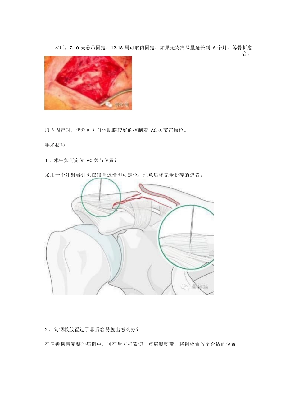 锁骨远端骨折与肩锁 关节损伤的治疗_第6页