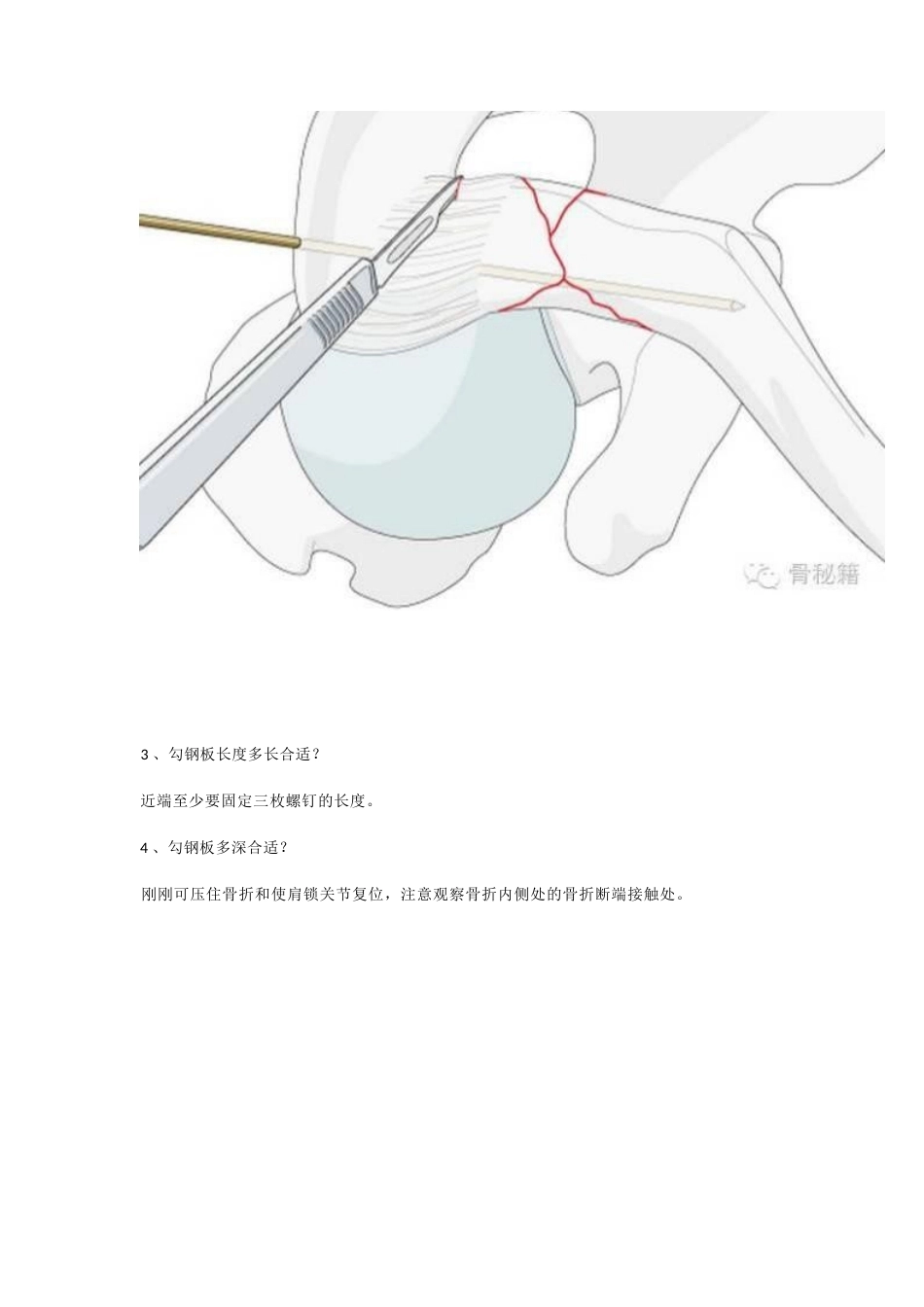 锁骨远端骨折与肩锁 关节损伤的治疗_第7页