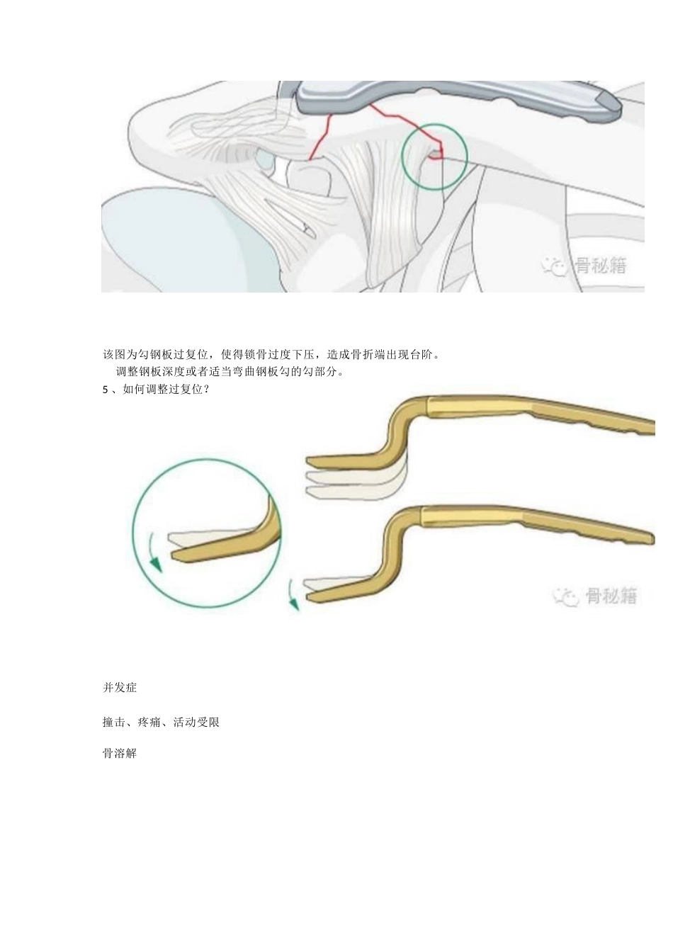 锁骨远端骨折与肩锁 关节损伤的治疗_第8页