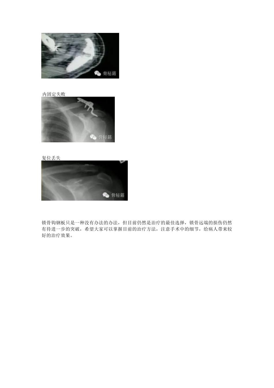 锁骨远端骨折与肩锁 关节损伤的治疗_第9页