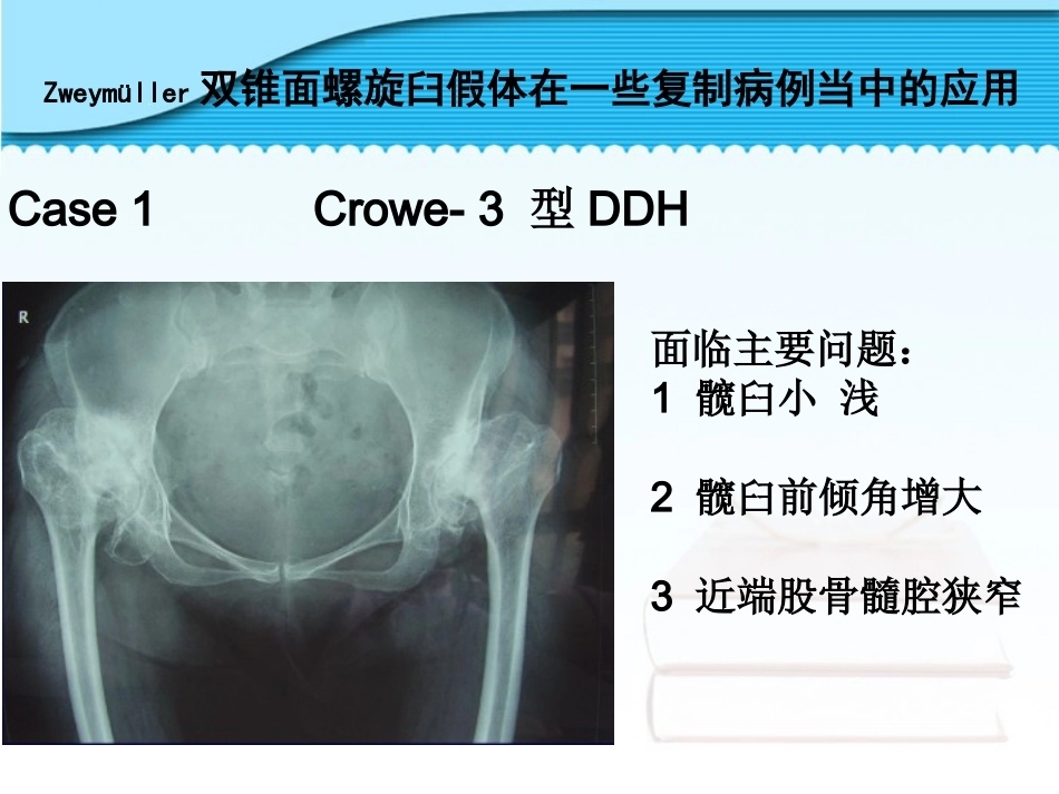 螺旋臼要 点_第10页