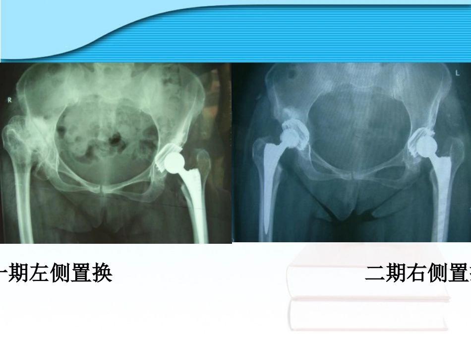 螺旋臼要 点_第11页