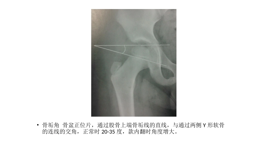 髋关节角度 测量_第12页