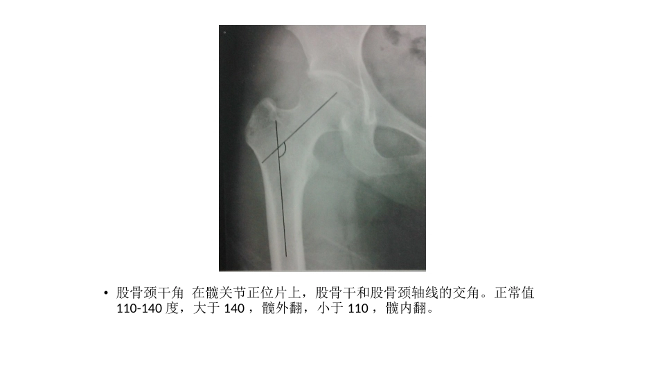 髋关节角度 测量_第2页