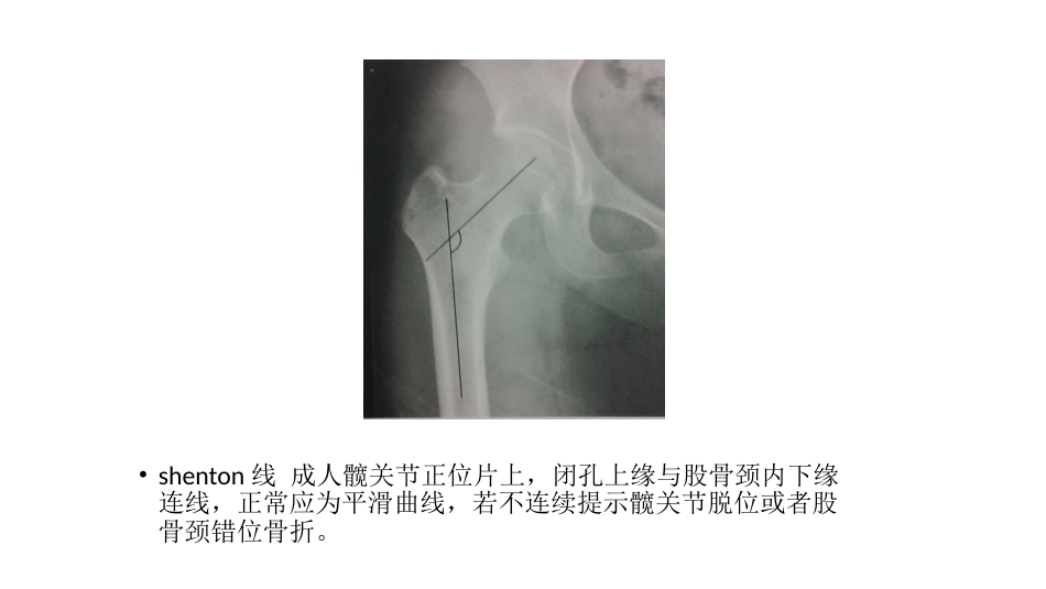 髋关节角度 测量_第3页