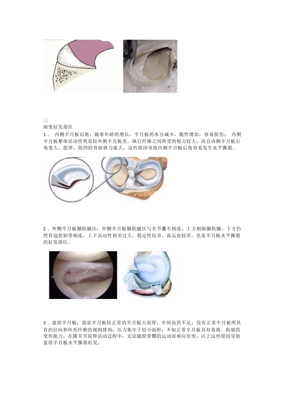 半月板水平撕裂的临床 诊治技巧_第2页