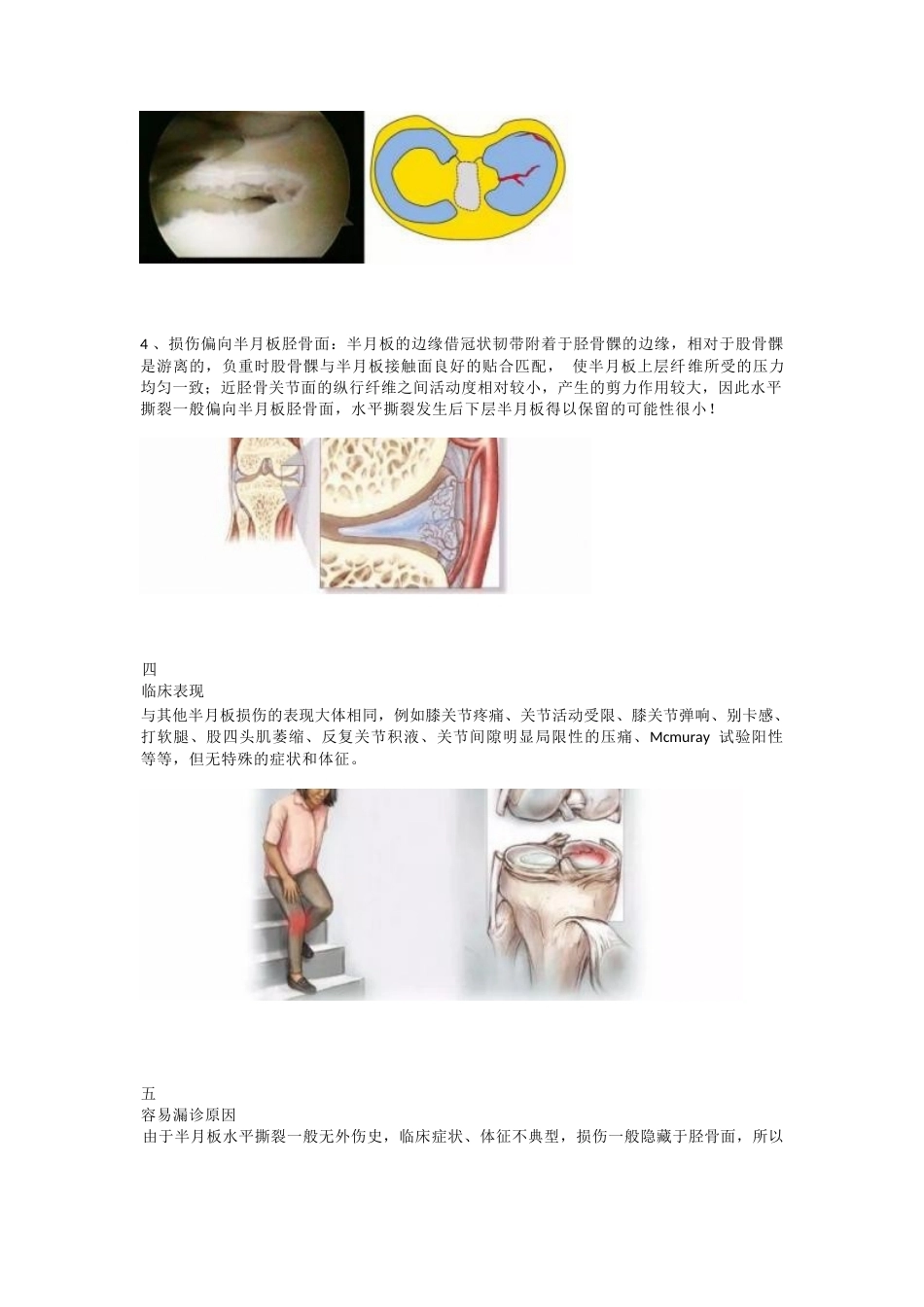 半月板水平撕裂的临床 诊治技巧_第3页