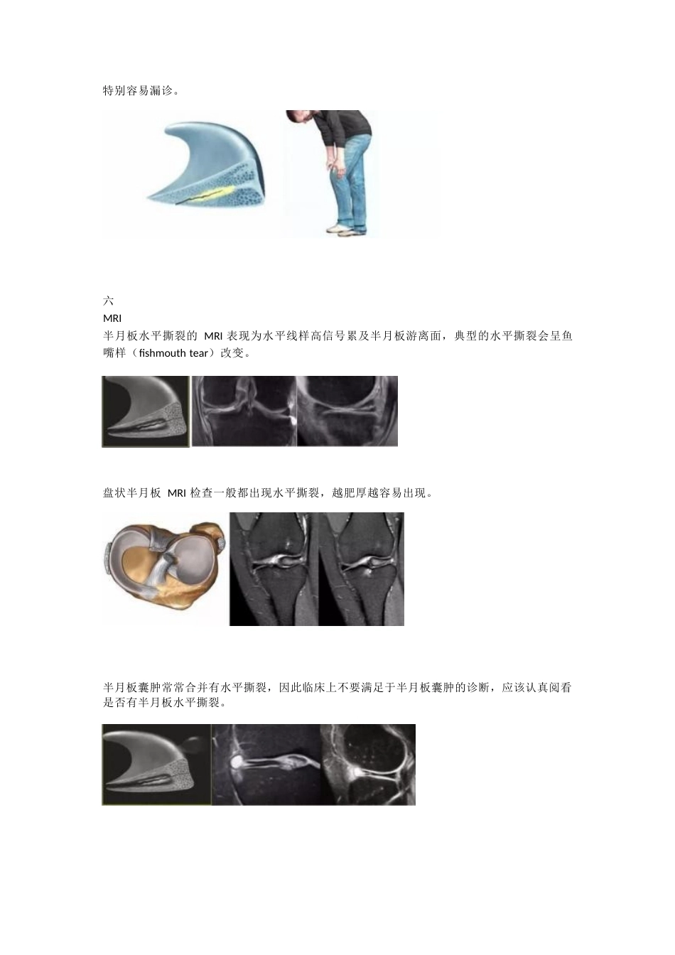 半月板水平撕裂的临床 诊治技巧_第4页