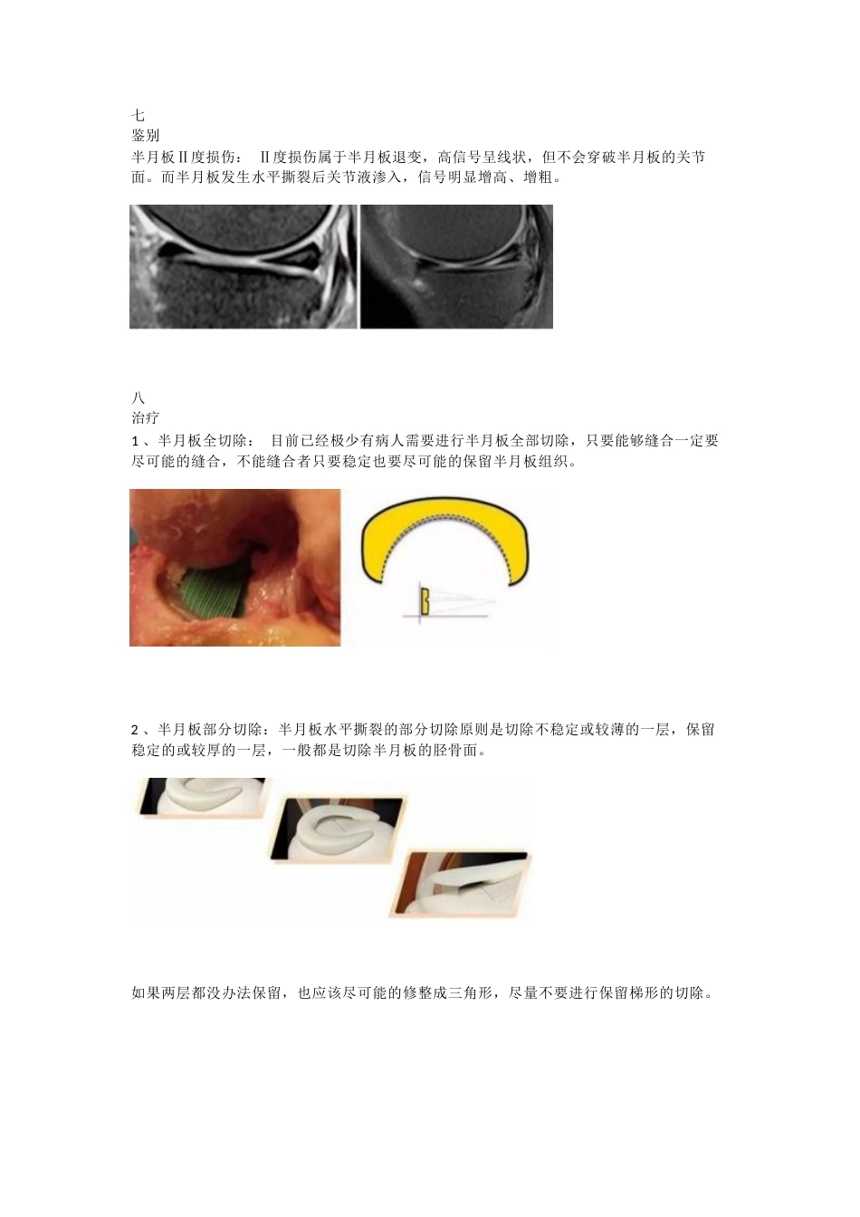 半月板水平撕裂的临床 诊治技巧_第5页