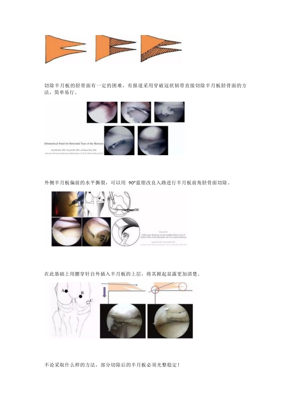 半月板水平撕裂的临床 诊治技巧_第6页