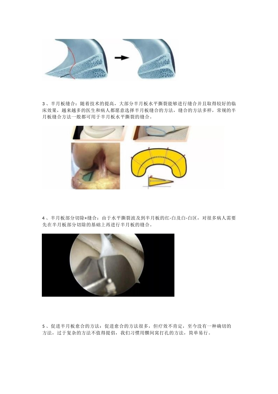 半月板水平撕裂的临床 诊治技巧_第7页