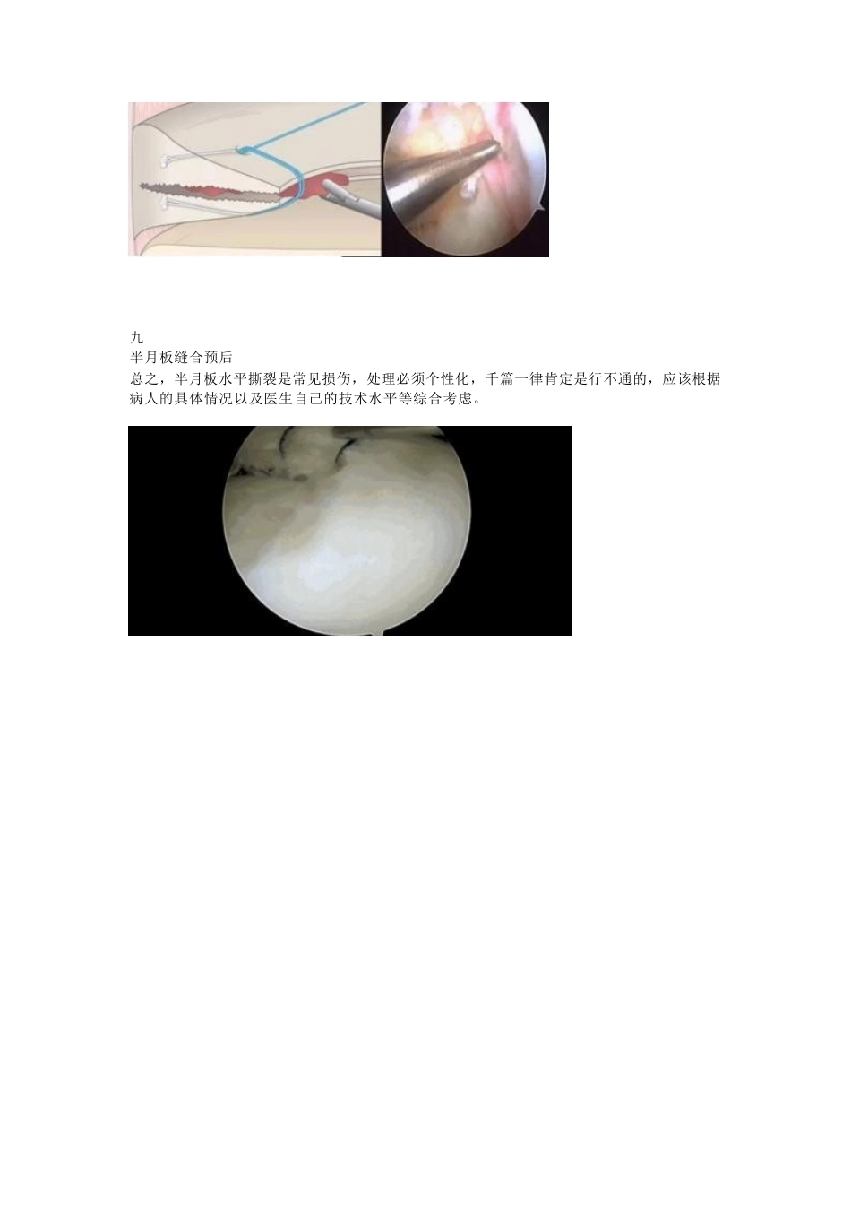 半月板水平撕裂的临床 诊治技巧_第8页
