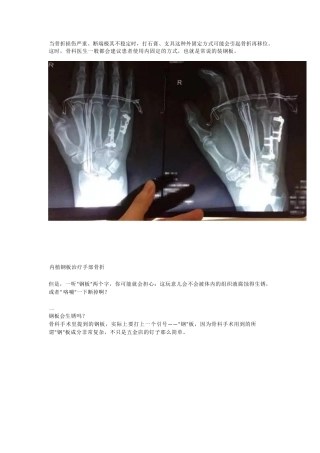 装了钢板，一定要取吗