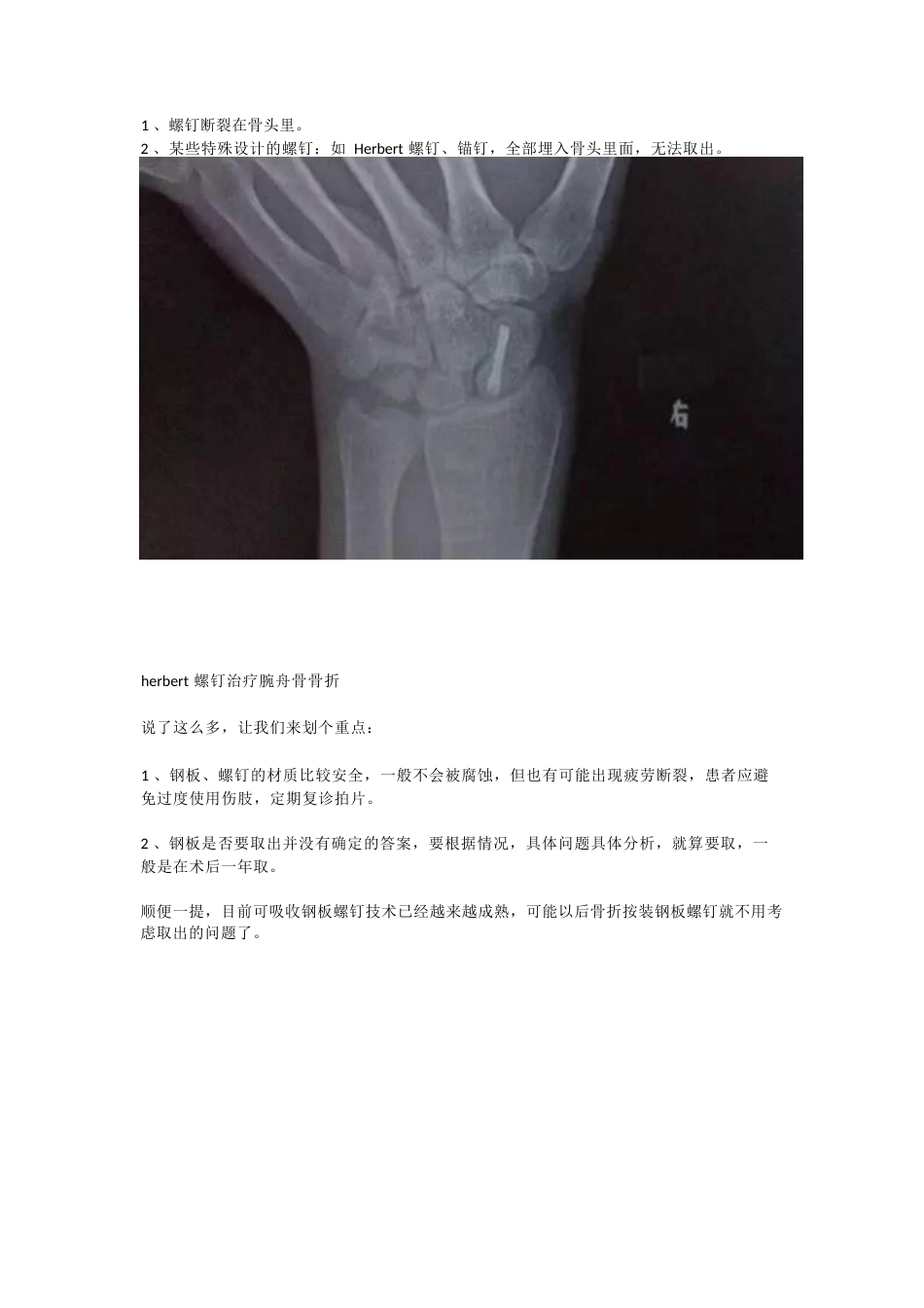 装了钢板，一定要取吗_第8页