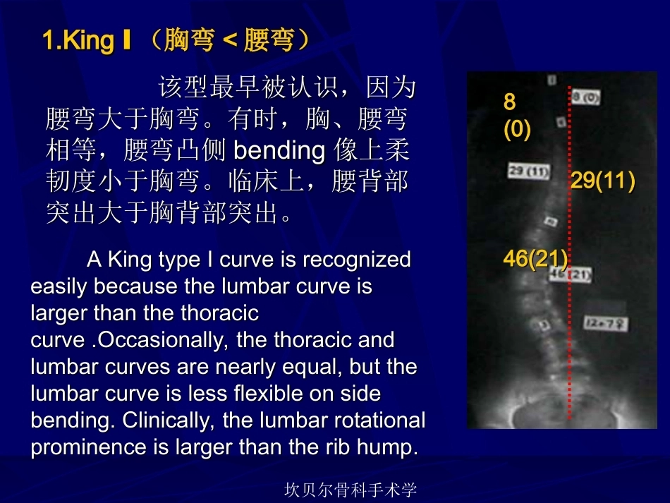 青少年特发性脊柱侧弯的分型_第11页