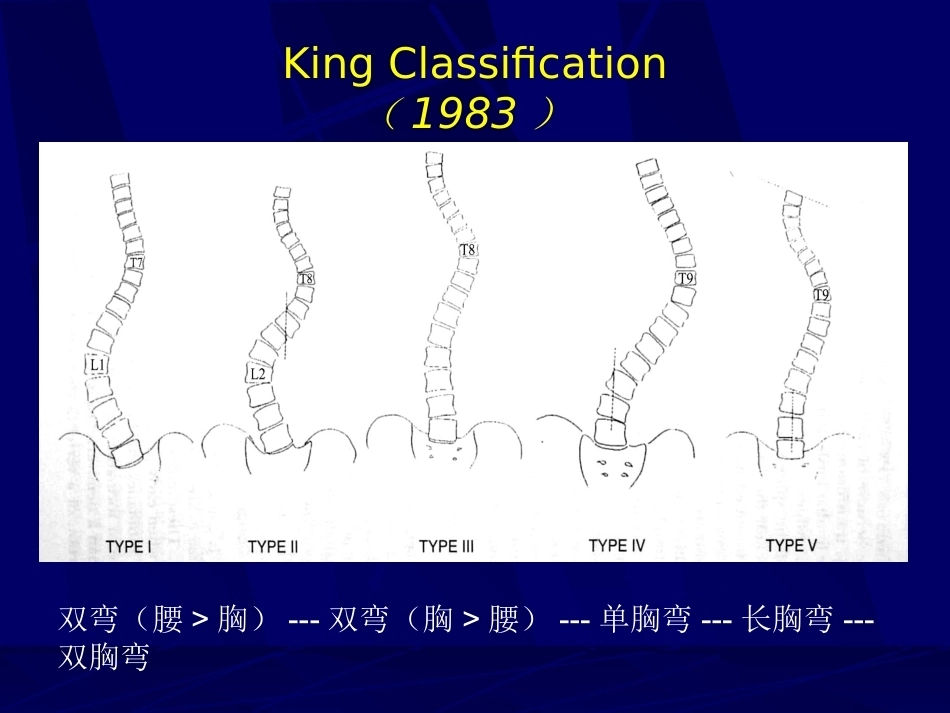 青少年特发性脊柱侧弯的分型_第9页