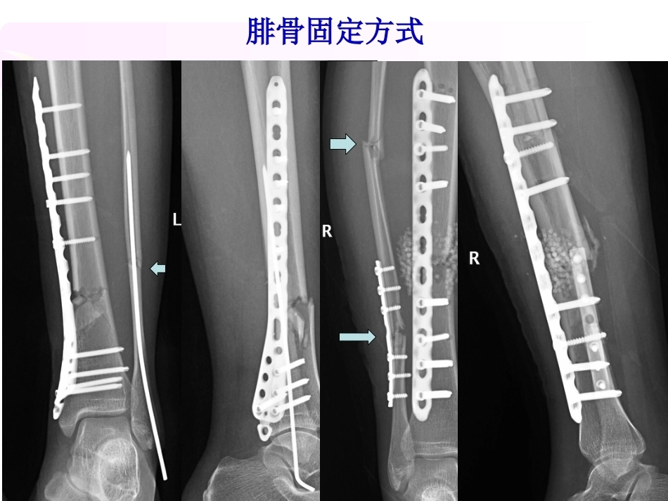 腓骨骨折 内固定._第10页