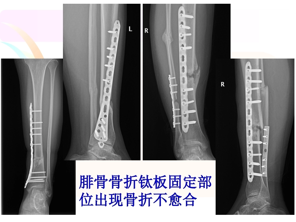 腓骨骨折 内固定._第12页