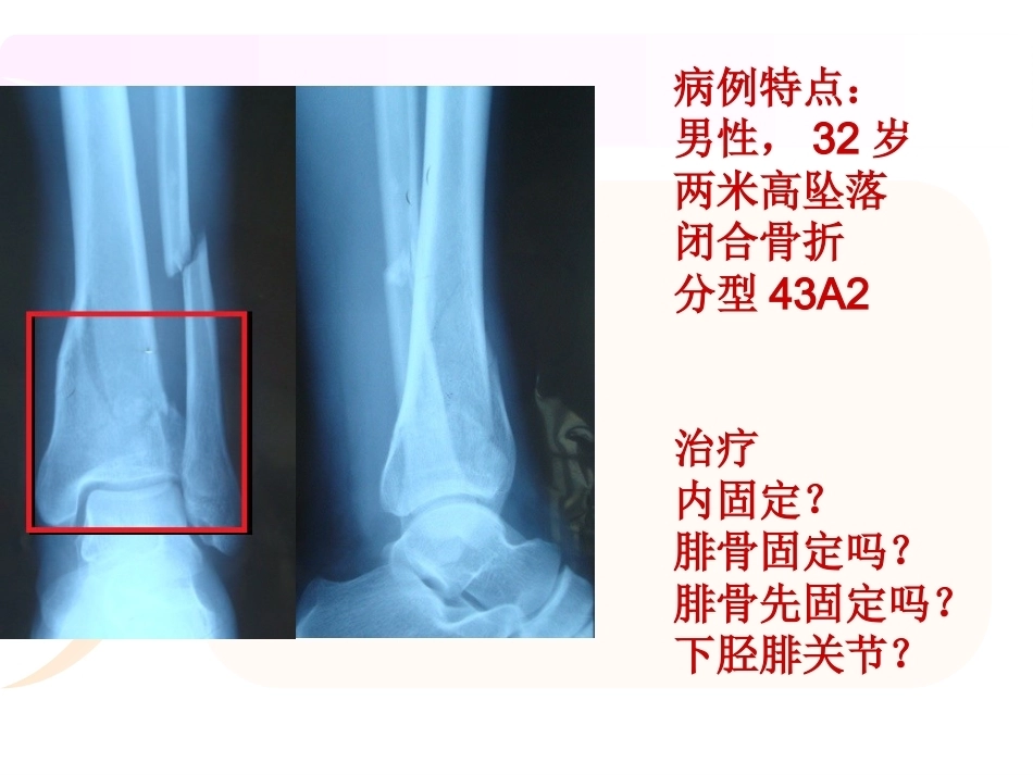 腓骨骨折 内固定._第2页