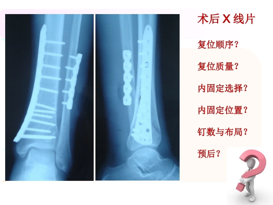 腓骨骨折 内固定._第3页