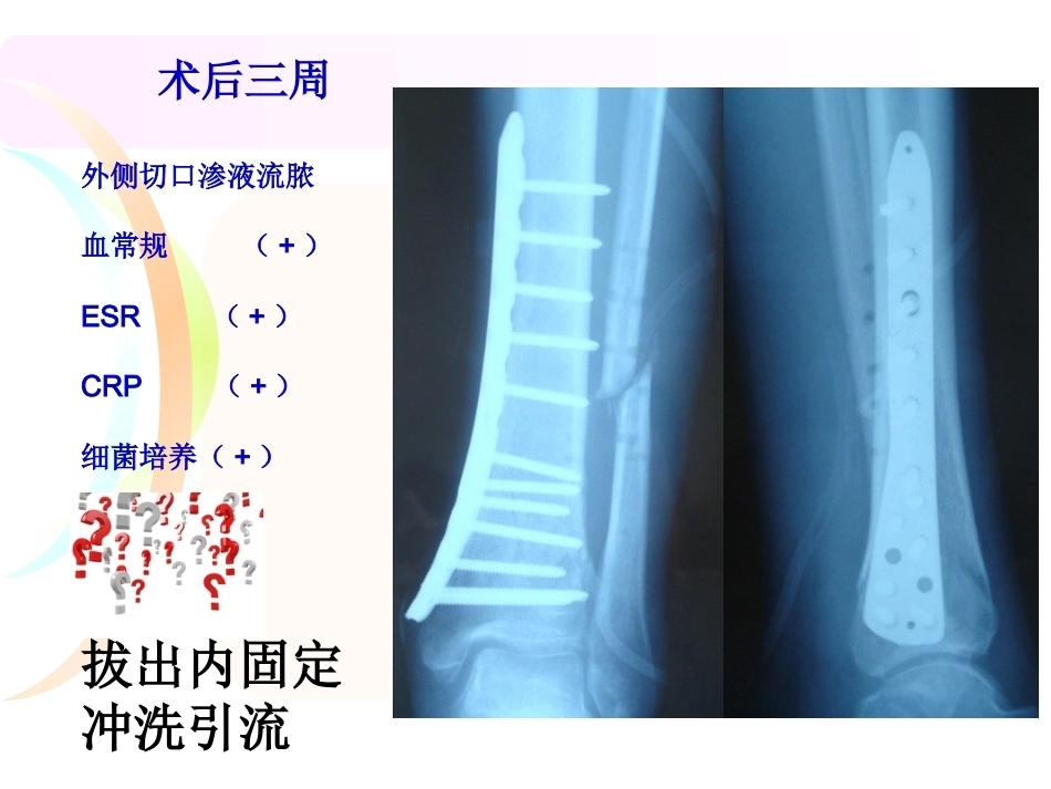 腓骨骨折 内固定._第4页