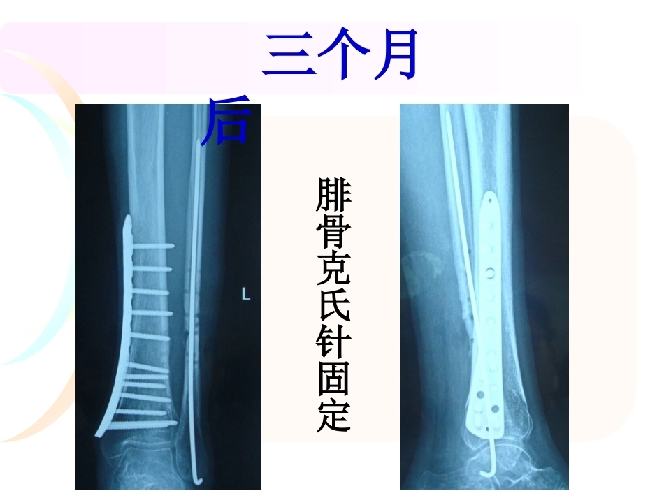 腓骨骨折 内固定._第5页