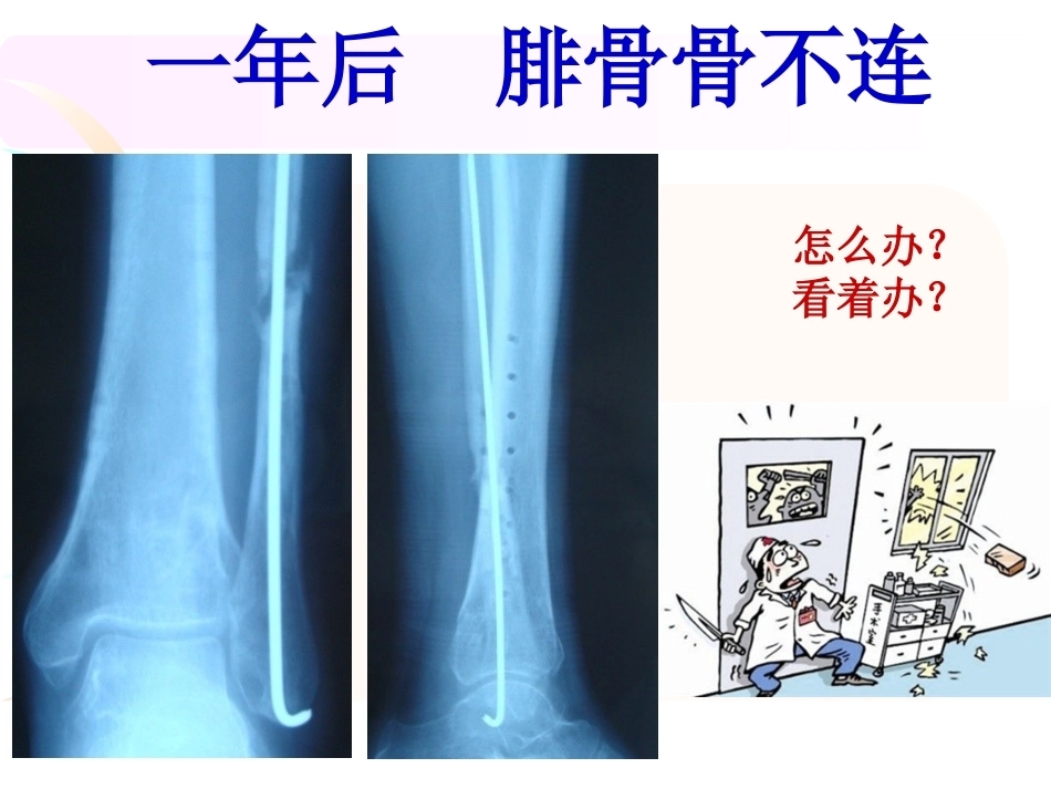 腓骨骨折 内固定._第6页
