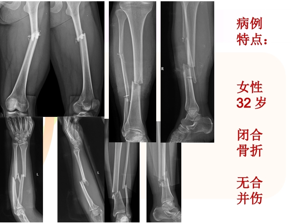 腓骨骨折 内固定._第8页