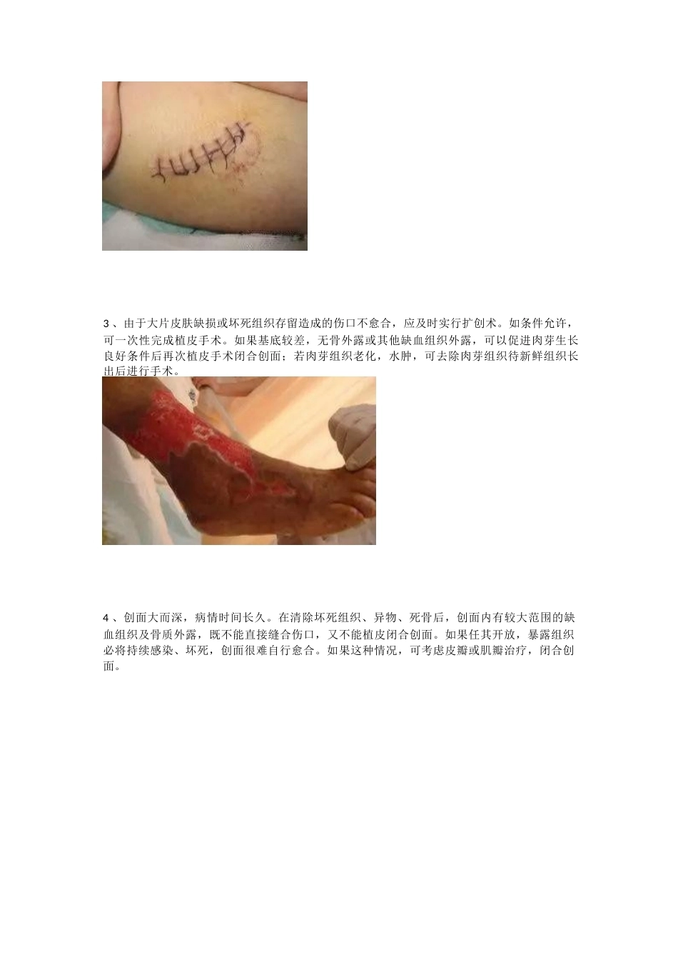 创面持久不愈合的原 因及治疗策略_第4页