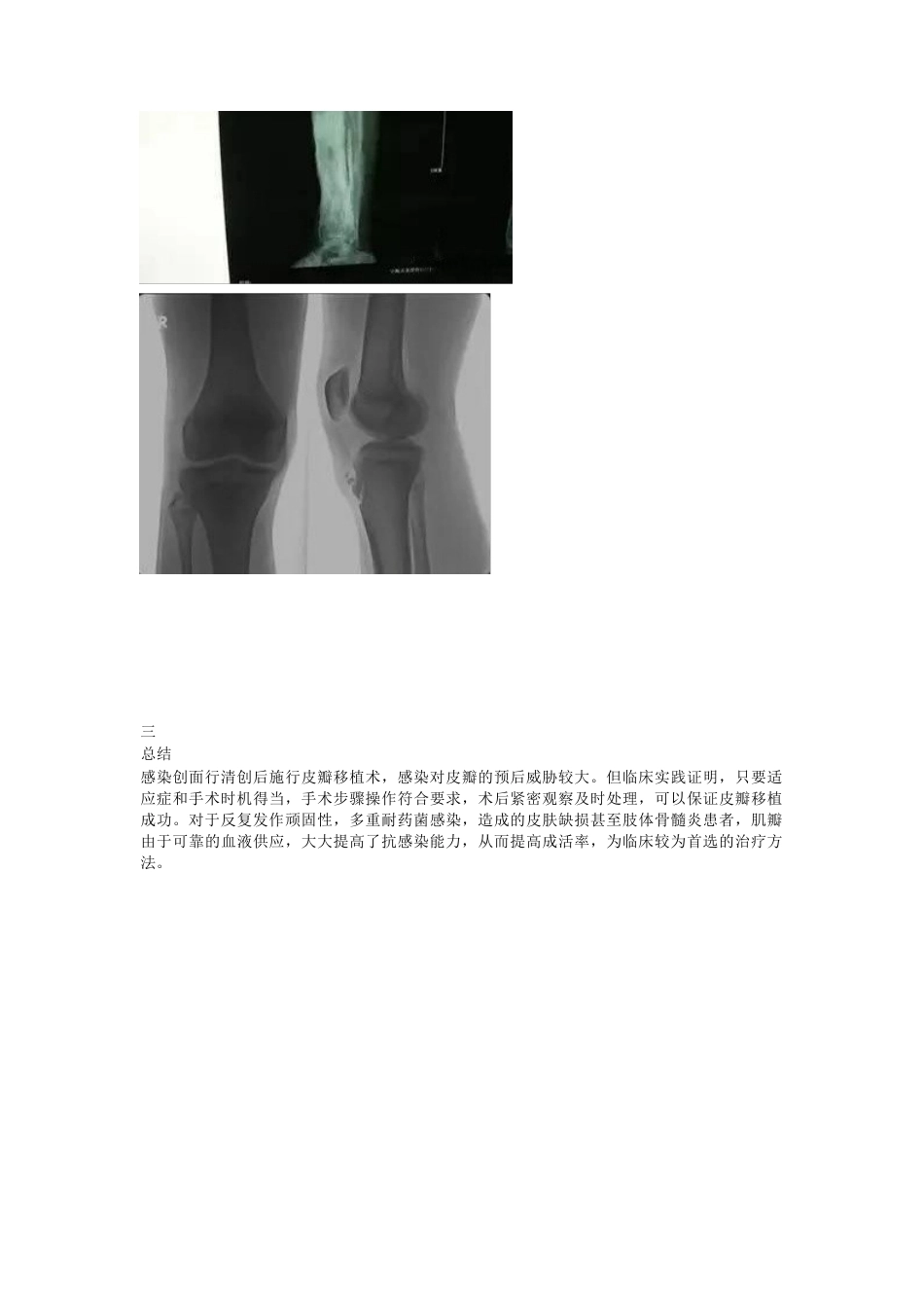 创面持久不愈合的原 因及治疗策略_第6页
