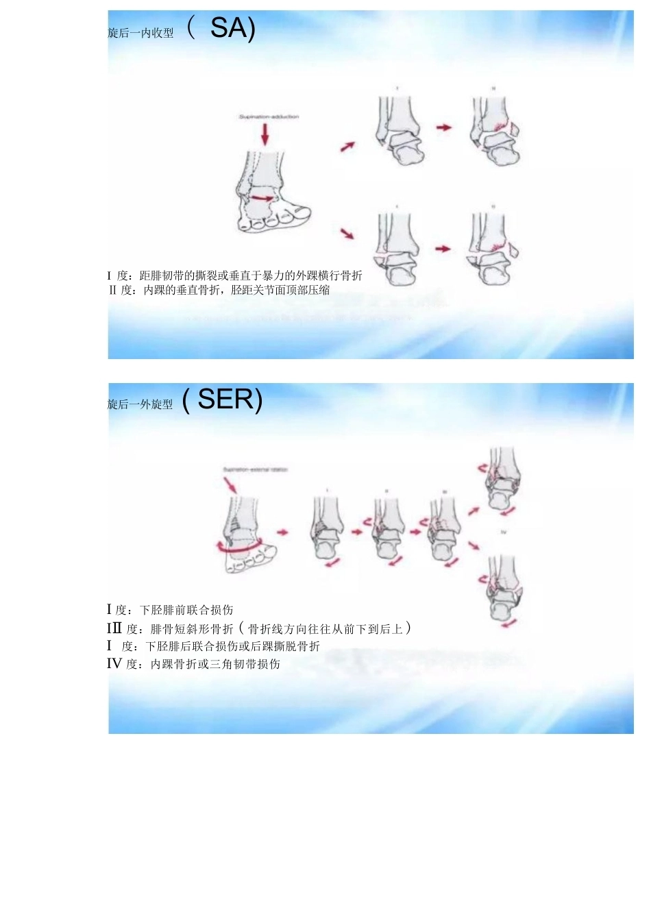 踝关节骨折的分型及治疗_第12页