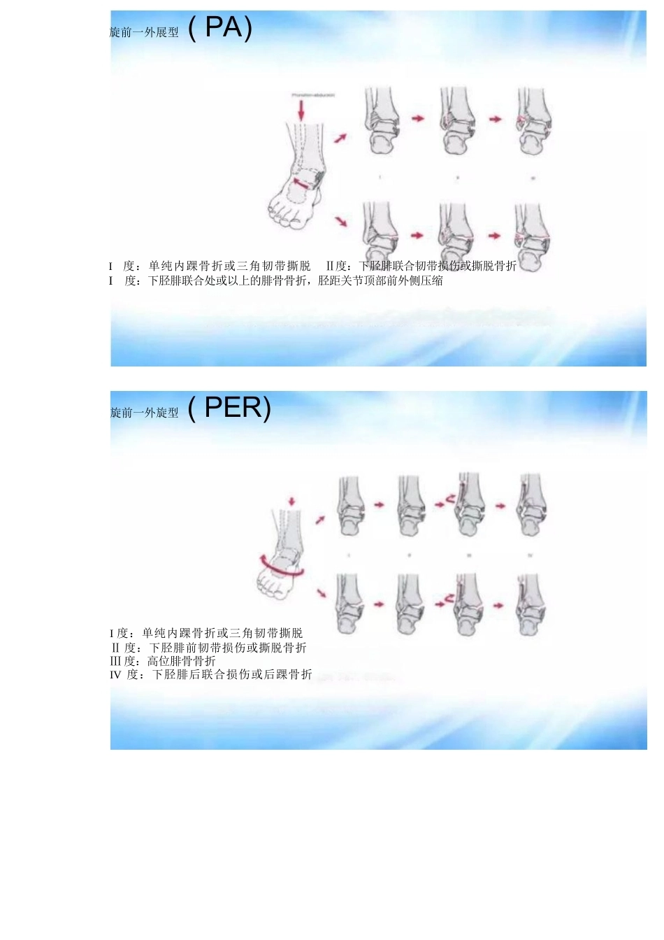 踝关节骨折的分型及治疗_第13页