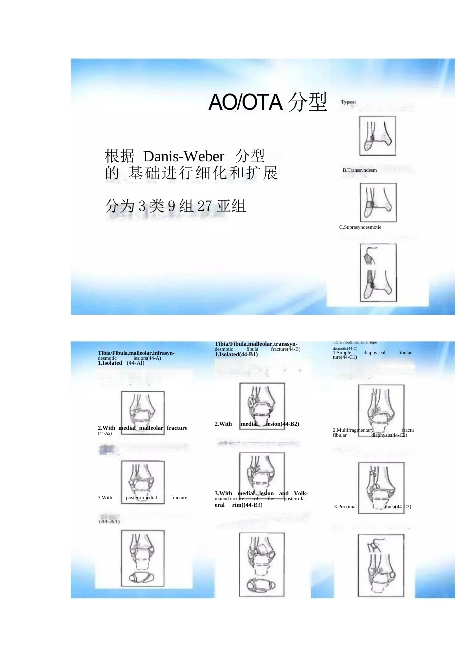 踝关节骨折的分型及治疗_第15页