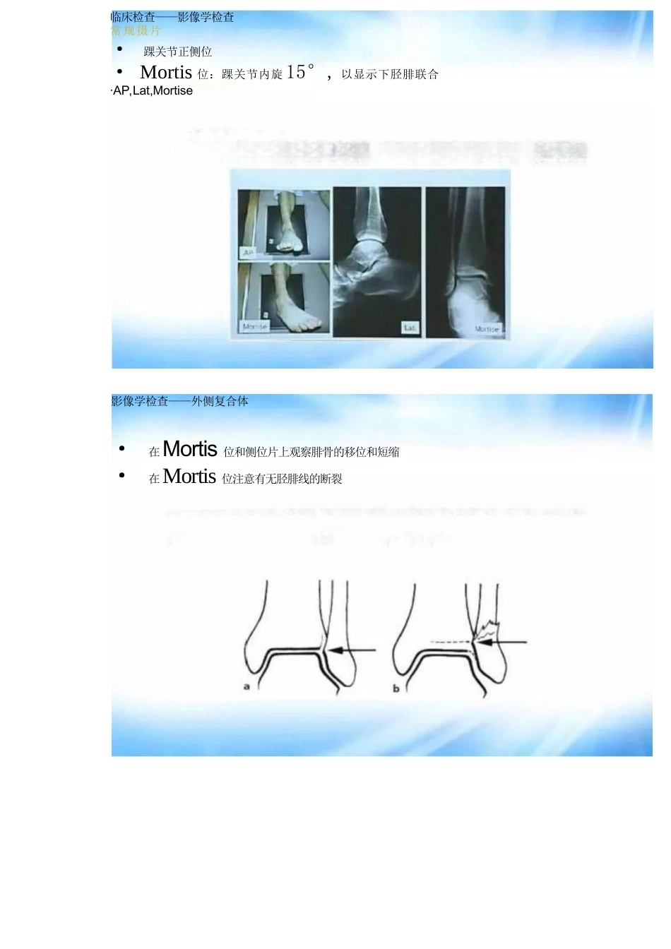 踝关节骨折的分型及治疗_第6页