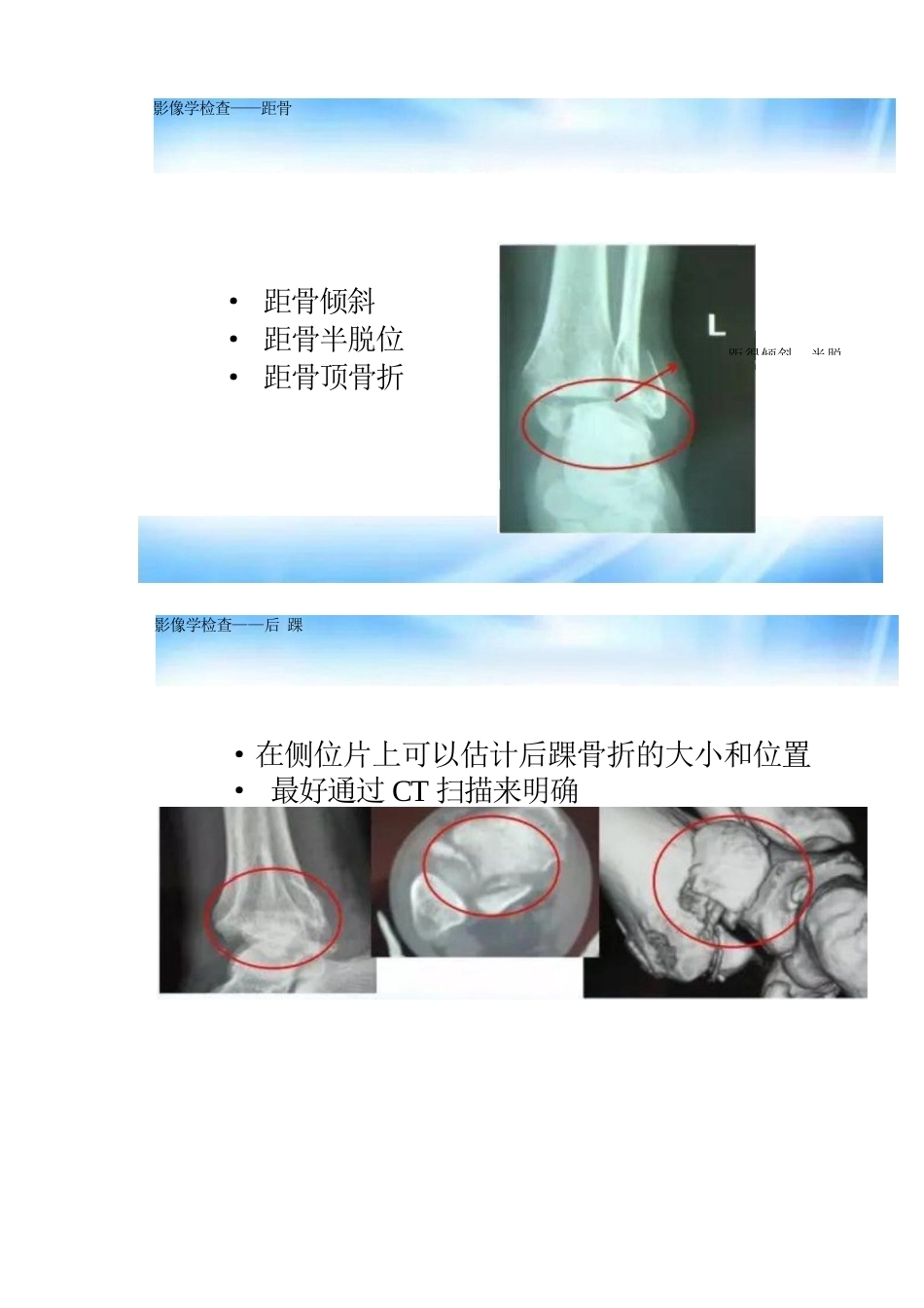 踝关节骨折的分型及治疗_第7页