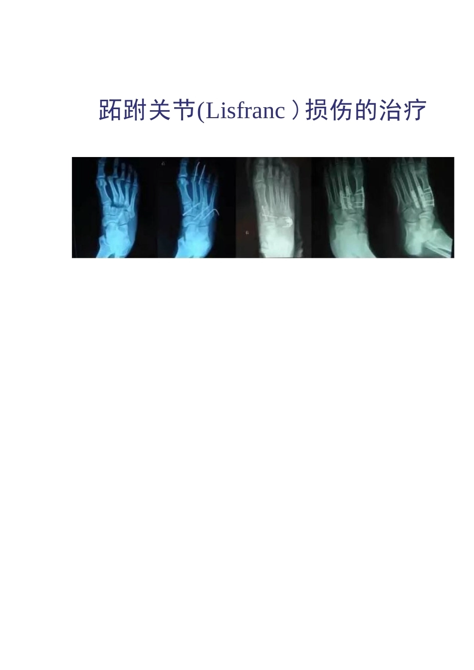 跖跗关节Lisfranc损伤的治疗_第1页