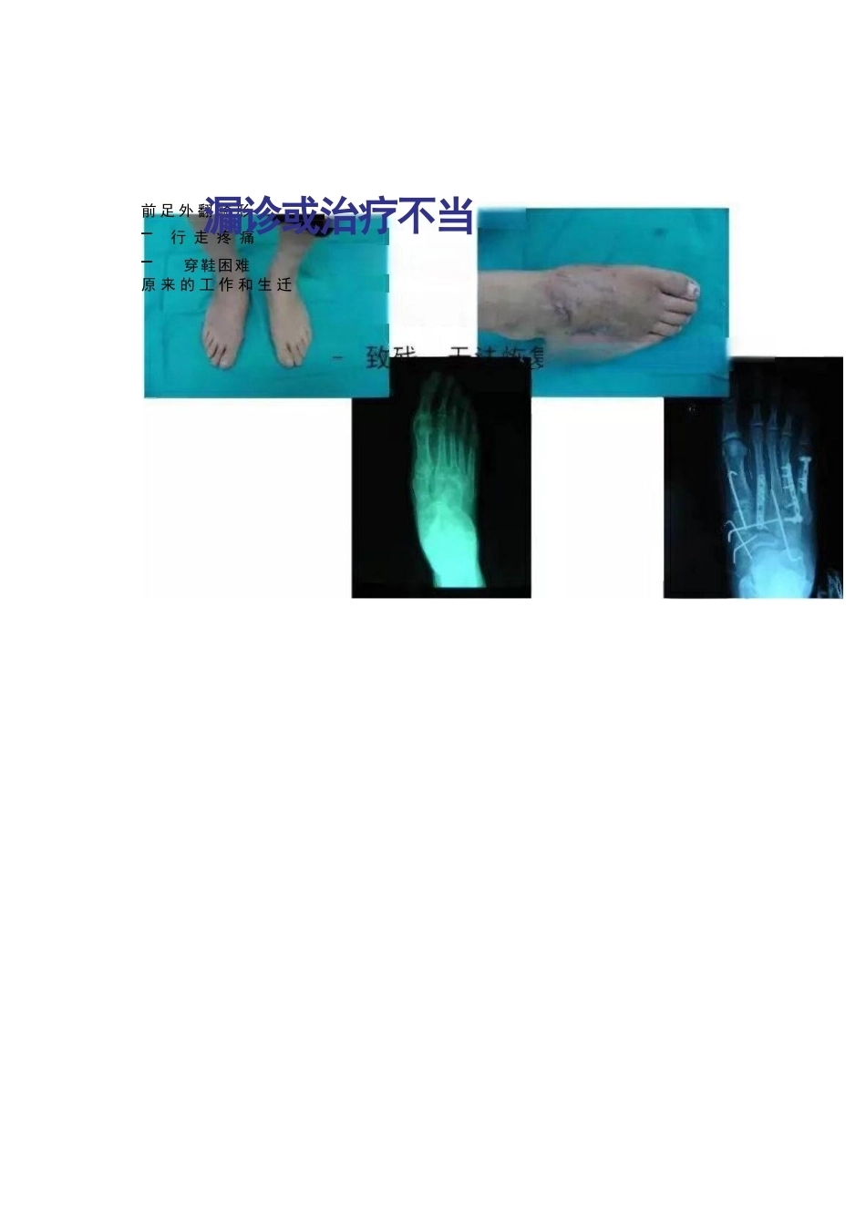跖跗关节Lisfranc损伤的治疗_第13页