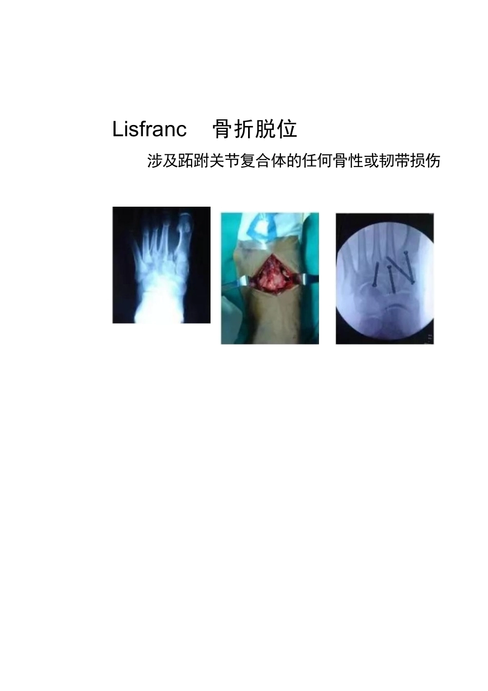 跖跗关节Lisfranc损伤的治疗_第3页