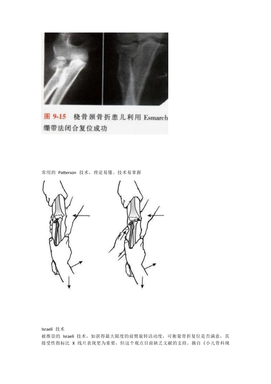 儿童桡骨头、颈骨折分型_第13页