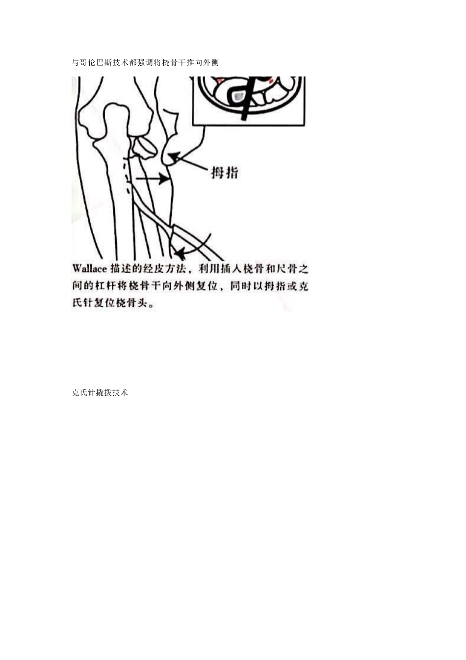 儿童桡骨头、颈骨折分型_第15页