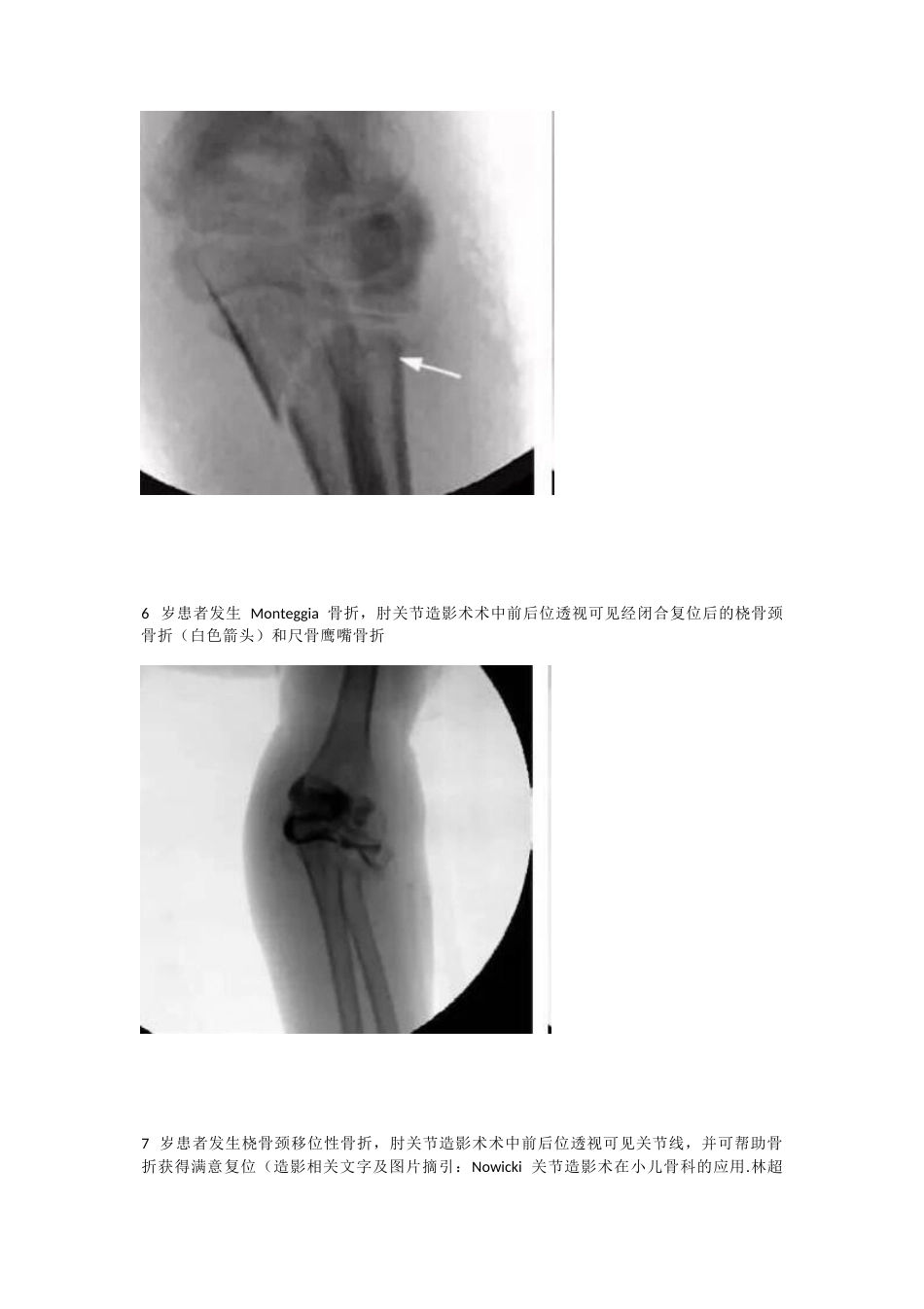 儿童桡骨头、颈骨折分型_第9页